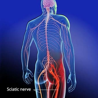 Sciatica Nerve Treatment