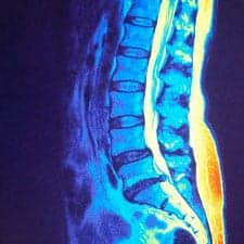 Herniated Discs Treatment