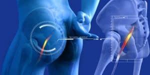 Treat Sciatica Nerve Pain